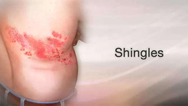 About Shingles
