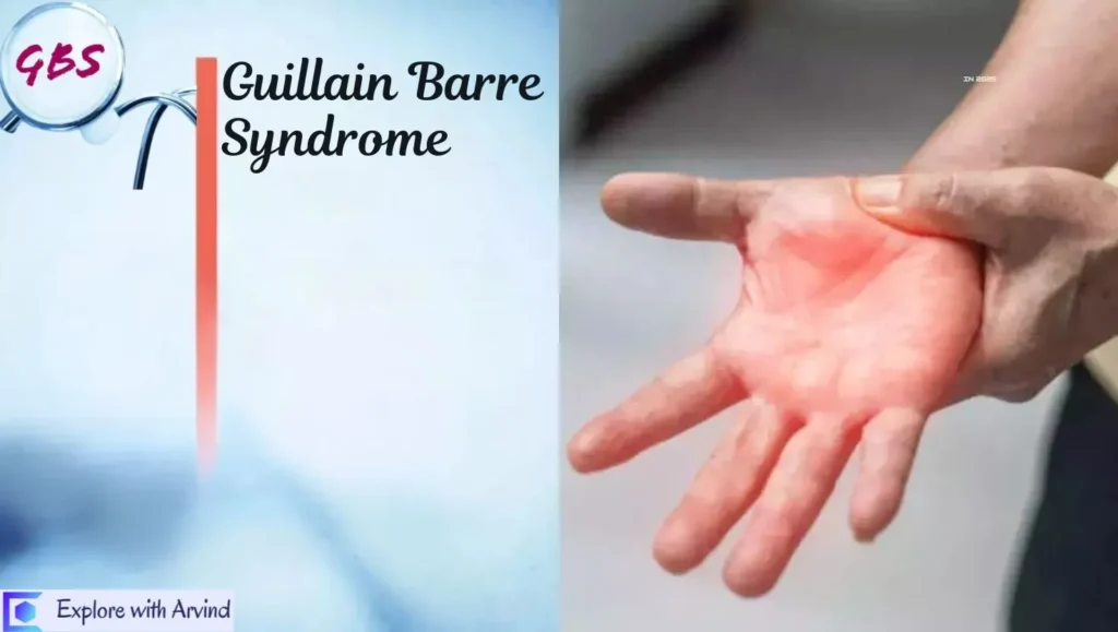 Guillain-Barre Syndrome: Symptoms, Causes and Treatments