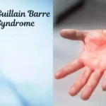 Guillain-Barre Syndrome: Symptoms, Causes and Treatments